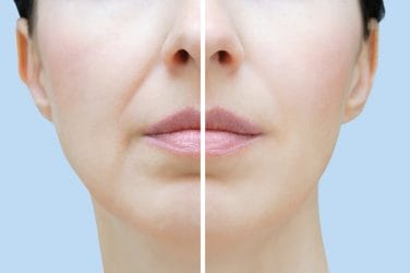 Vrouw heeft een behandeling ondergaan om haar neus-lippenplooi minder te laten opvallen