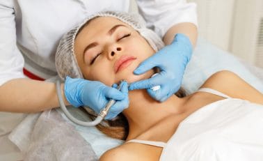 microdermabrasie om de hoornlaag te verdunnen bij hormonale acne.