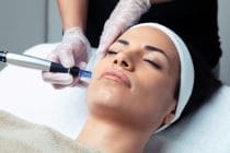 hoe werkt microneedling