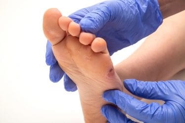 Vriendelijkheid Typisch Naar boven Vraag aan de pedicure: waarom komt een likdoorn terug? - Wellness Academie